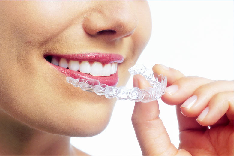 Invisalign In Toronto